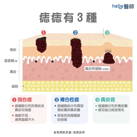 長毛的痣